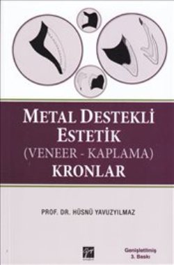 Metal Destekli Estetik (Veneer-Kaplama)Kronlar